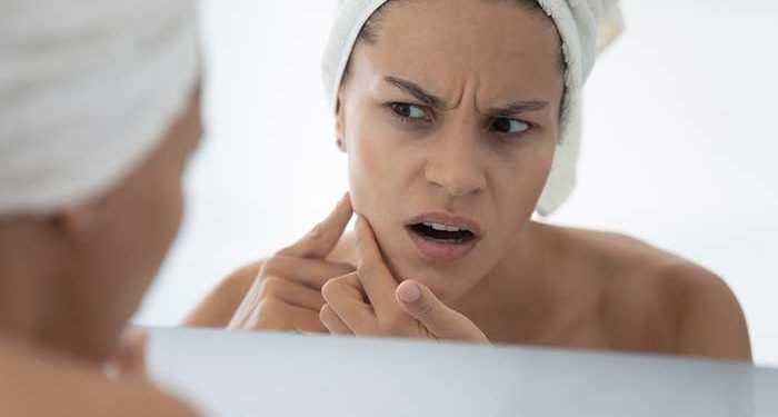 7 Lesser-Known Reasons for Acne Breakouts