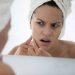 7 Lesser-Known Reasons for Acne Breakouts